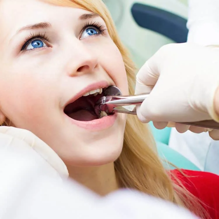 Tooth Extraction