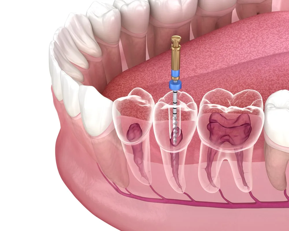 Root Canal Procedure Drilling A Hole Through The Tooth