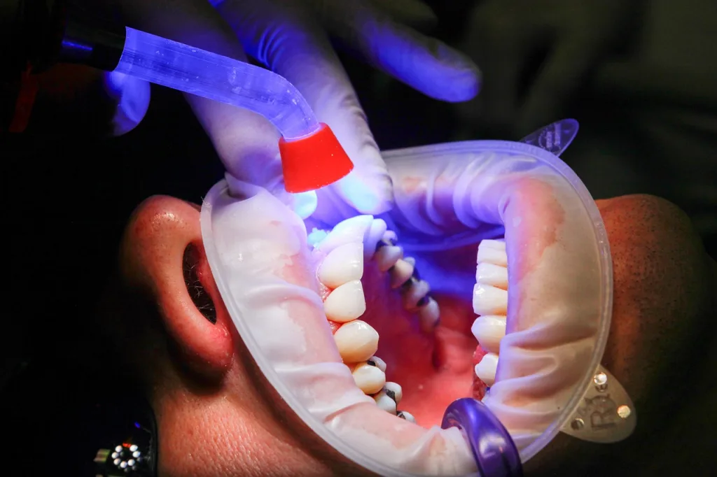 Photo of Dental Facet UV Light Curing