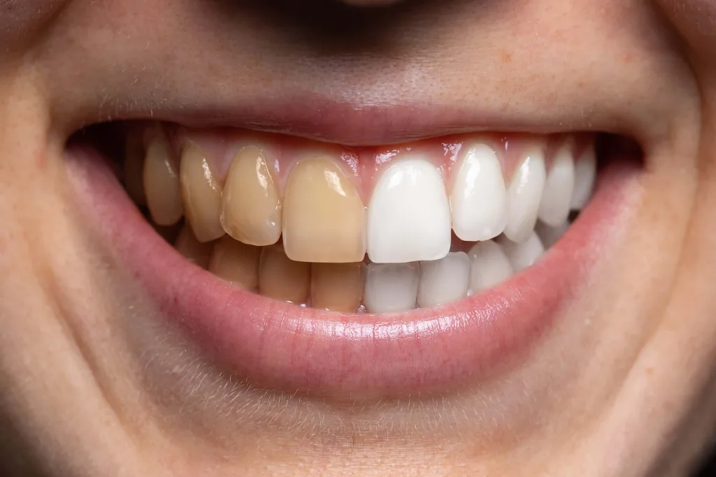 Before and after teeth whitening view. A young Caucasian woman smiles and is seen close up